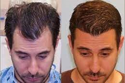 Front line hair fixing