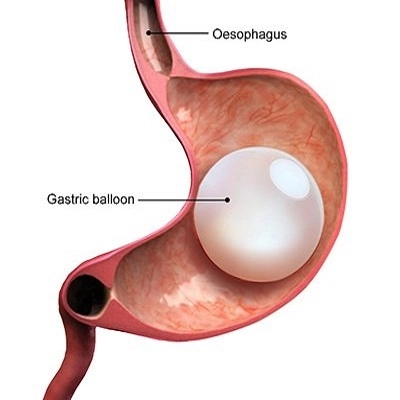 Gastric Balloon Placement in Abu Dhabi