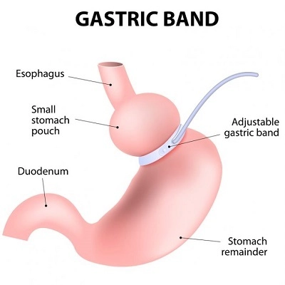 Gastric Banding 2 Gastric Banding in Abu Dhabi & Al Ain lap band surgery