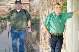 Gastric-Plication-in-Abu-Dhabi