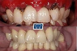 Gum-Bleeding-Treatment-in-Abu-Dhabi