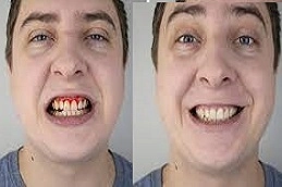 Gum-Bleeding-Treatment