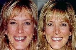 Gum-Contouring-in-Abu-Dhabi-Abu-Dhabi