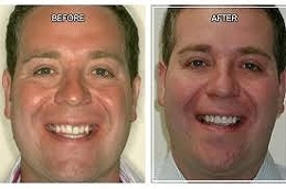 Gum-Contouring-in-Abu-Dhabi-Al-Ain.