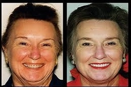 Gum Contouring 5 Gum-Contouring