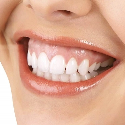 Gummy Smile Treatment 2 Gummy Smile Treatment in Abu Dhabi & Al Ain Gum Contouring UAE
