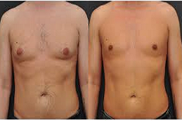 Gynecomastia Clinic in UAE