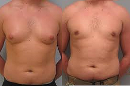 Gynecomastia in Abu Dhabi & Al Ain