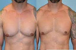 Gynecomastia in Abu Dhabi