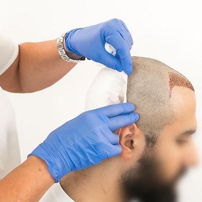 Hair Transplant Clinic in Abu Dhabi UAE
