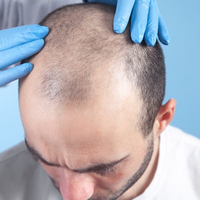 Hair Transplant for Genetic Hair loss in Abu Dhabi Al Ain