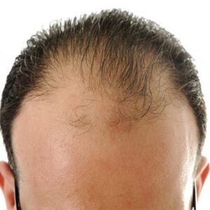 Blog 1 Hair Transplant for Male Pattern Baldness in Abu Dhabi Al Ain