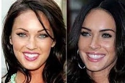 Hollywood Smile Makeover 5 Hollywood-Smile-Makeover-in-Abu-Dhabi-Al-Ain