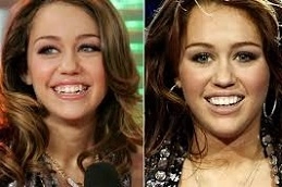 Hollywood-Smile-Makeover