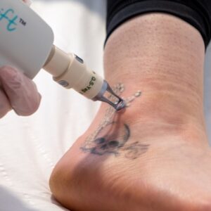 How Does Tattoo Removal Work Laser Tattoo Removal Abu Dhabi