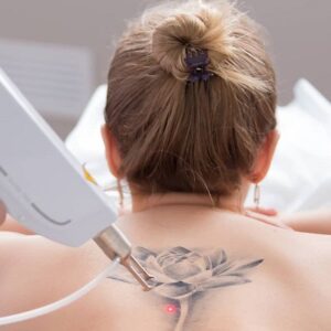 Blog 1 How Many Sessions to Remove a Tattoo in Abu Dhabi Al Ain