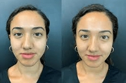 Hyaluronic-Acid-Injections-in-Abu-Dhabi-Al-Ain