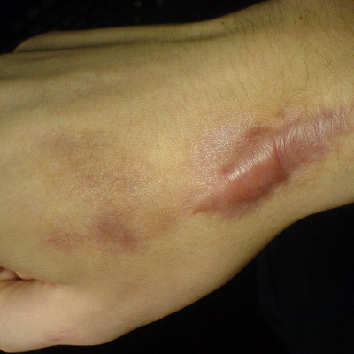 Hypertrophic Scars Treatment in Abu Dhabi khalifa City