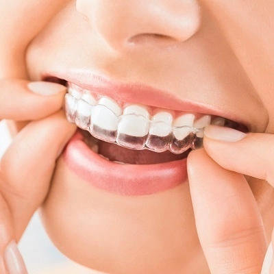 Invisalign Braces Treatment 2 Invisalign Braces Treatment in Abu Dhabi & Al Ain Cost & Price