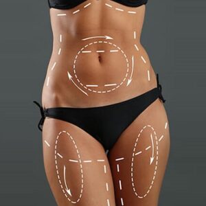 Blog 1 Is-Liposuction-Surgery-Permanent-in-Abu-Dhabi-Al-Ain