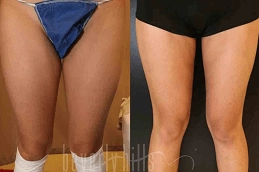 J-Plasma-for-Thighs-and-Arms-Clinic-in-Abu-Dhabi-Al-Ain