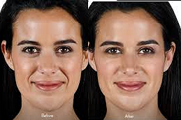Juvederm Fillers Clinic in UAE