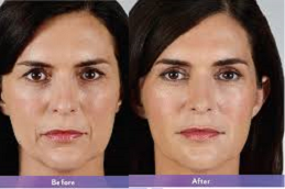 Juvederm Fillers Clinic