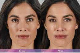 Juvederm Fillers in Abu Dhabi & Al Ain