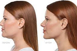 Kybella Treatment in Abu Dhabi & Al Ain