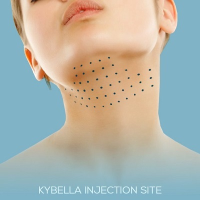 Kybella Treatment 2 Kybella Treatment in Abu Dhabi khalifa City Al Ain Cost Price