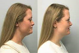 Kybella Treatment in Abu Dhabi