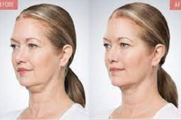 Kybella Treatment 5 Kybella Treatment