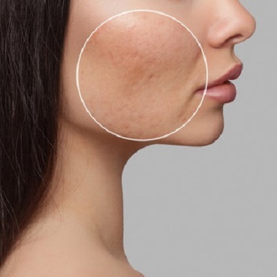 Large Pores Treatment 3 Proven Ways in Abu Dhabi Al Ain