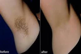 Laser Hair Bleaching Abu Dhabi