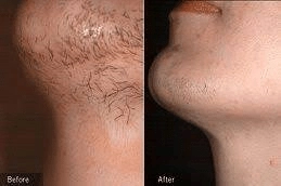 Laser Hair Bleaching Dubai