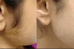 Laser Hair Bleaching