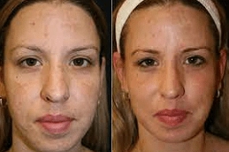 Laser Photo Rejuvenation Clinic in Abu Dhai