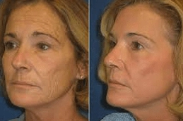 Laser Photo Rejuvenation Clinic in UAE Abu Dhabi