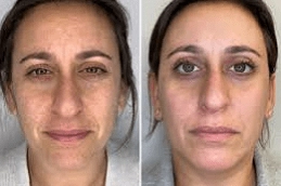 Laser Photo Rejuvenation in Abu Dhabi