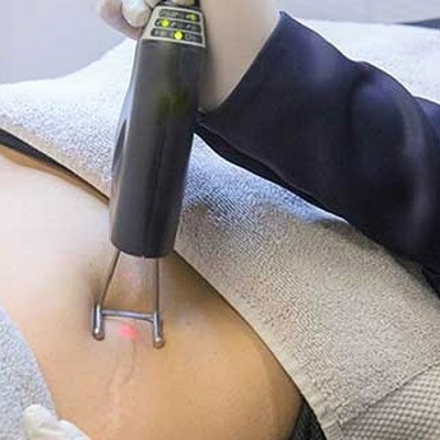 Laser scar Removal Abu Dhabi Al Ain Scar Laser Removal Price