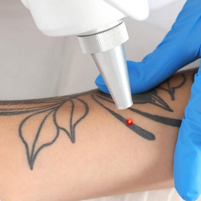 Laser Tattoo Removal Cost in Abu Dhabi
