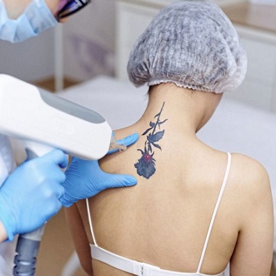 Can Lasers Remove The Tattoo Completely? 2 Can Lasers Remove The Tattoo Completely