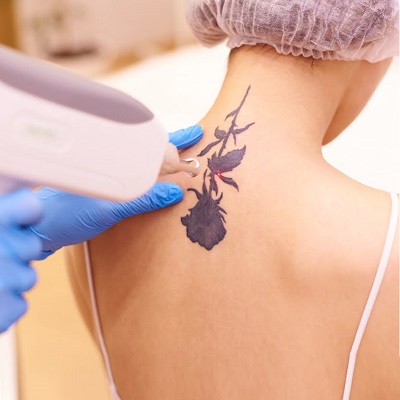 Laser Tattoo Removal Side Effects in Abu Dhabi 2 Laser Tattoo Removal Side Effects in Abu Dhabi Al Ain