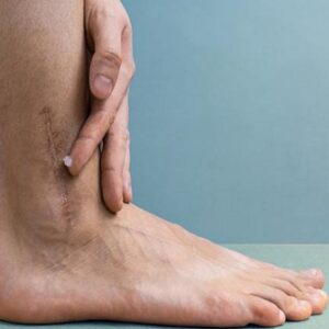 Laser Treatment for Scars on Legs in Abu Dhabi Al Ain