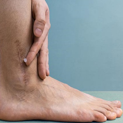 Laser Treatment for Scars on Legs in Abu Dhabi Al Ain