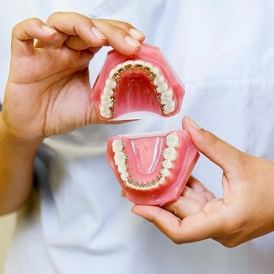 Lingual Braces Treatment 2 Lingual Braces Treatment in Abu Dhabi & Al Ain Lingual Braces Cost