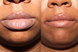 Lip-Reduction-Surgery-in-Abu-Dhabi-Before-After