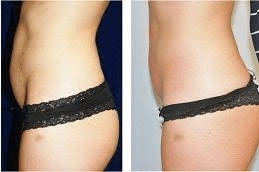 Liposonix Treatment inAbu Dhabi