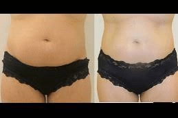 Liposonix Treatment 5 Liposonix Treatment