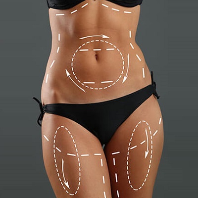 Liposuction Recovery: Timeline, Tips, and More 5 Liposuction Recovery Timeline Tips and More Enfield Royal Clinic